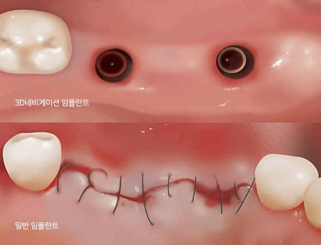3D 네비게이션 임플란트